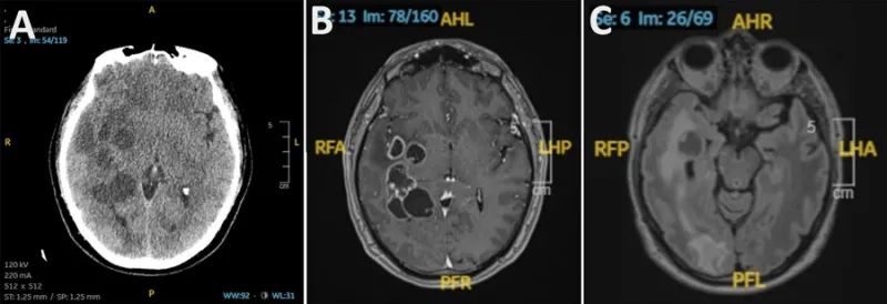 Un tío en España fue al médico por un dolor de cabeza y le encontraron bichos en el cerebro